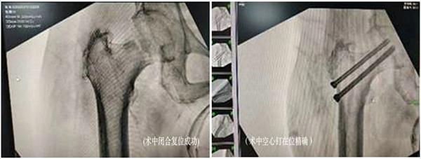 华信投资 青岛市即墨区人民医院：“螺钉上的芭蕾”